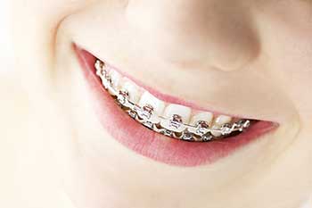 The image shows a person smiling, with their teeth prominently featuring braces.